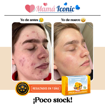 Jabón de cúrcuma  y Caléndula | tratamiento contra manchas y acné